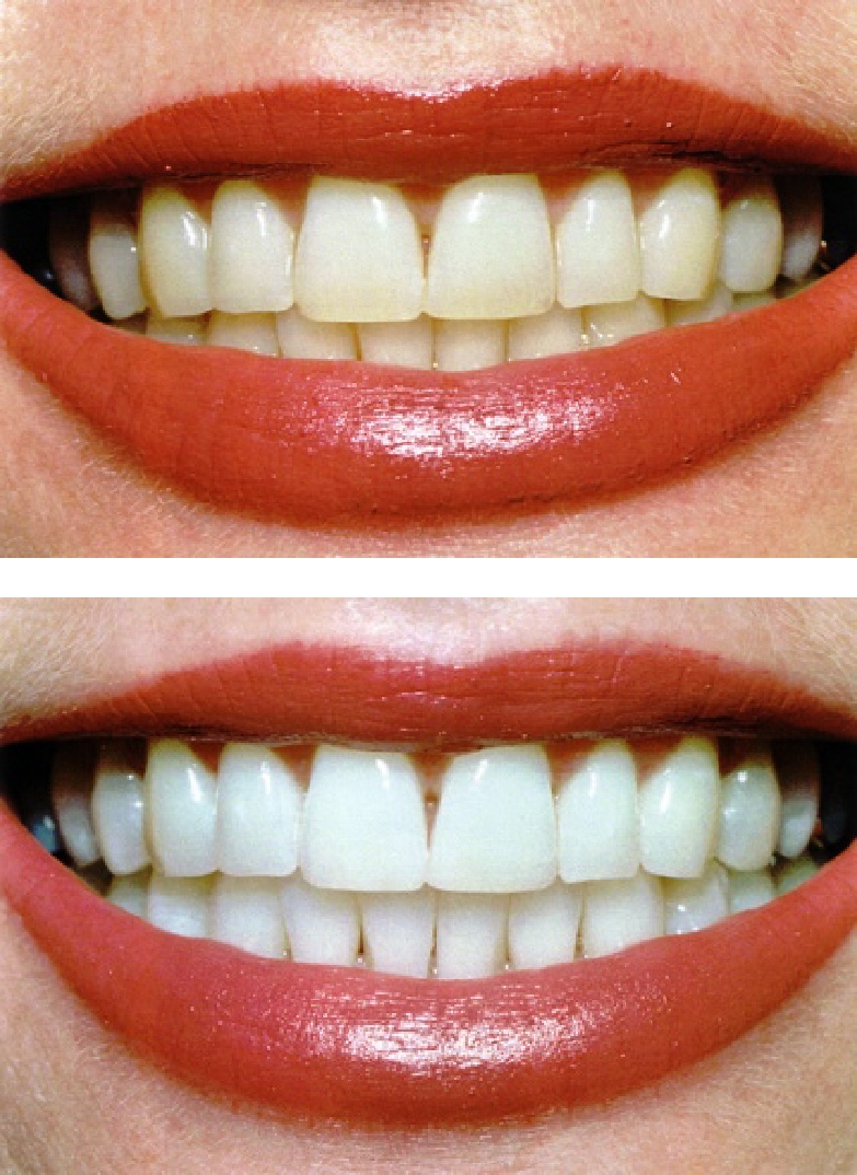 teeth whitening Best teeth whitening products